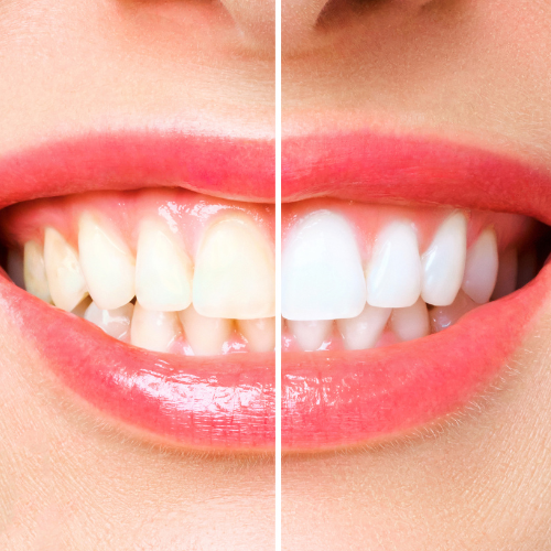 Teeth Whitening in Fayetteville, GA